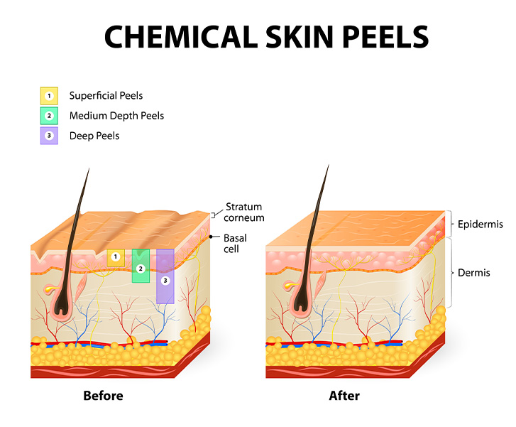 chemical skin peel diagram