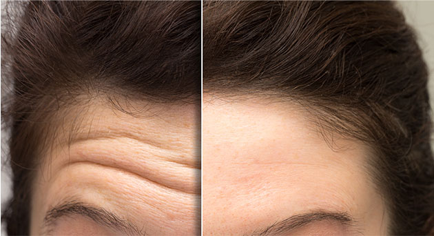 Botox Treatments