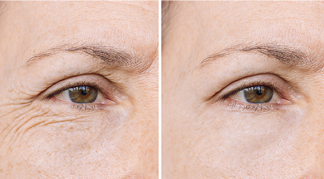 botox wrinkles