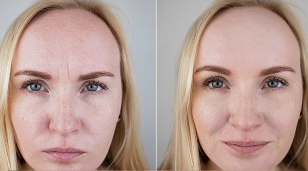 botox wrinkles