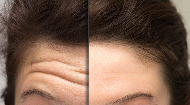 botox wrinkles