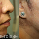 aerolase laser facial