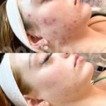 aerolase laser facial