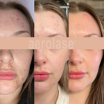 aerolase laser facial