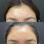 aerolase laser facial