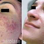 aerolase laser facial