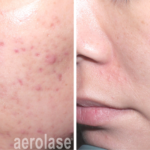 aerolase laser facial