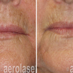 aerolase laser facial