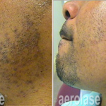 aerolase laser facial