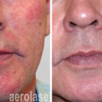 aerolase laser facial