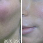 aerolase laser facial