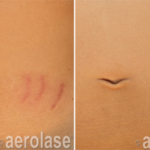 aerolase laser facial