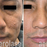 aerolase laser facial