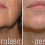 aerolase laser facial