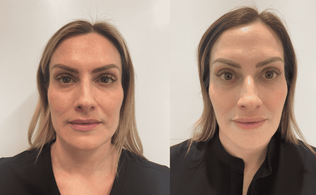 Masseter Botox Before and After