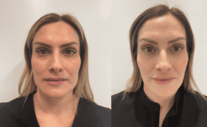 Masseter Botox Before and After - The Jaw-Sculpting Magic