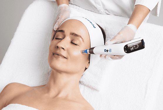 microneedling