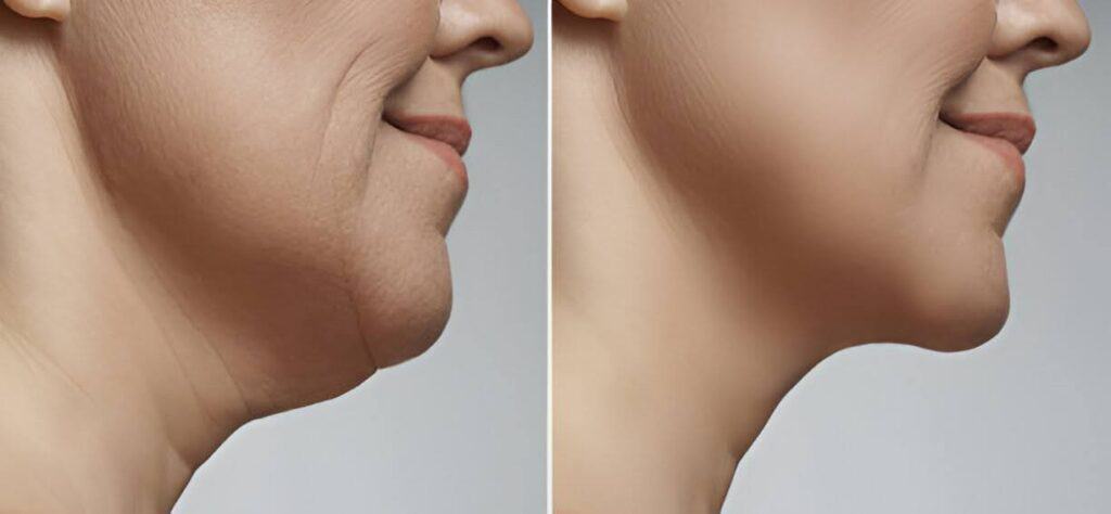 Before and After Kybella Treatment