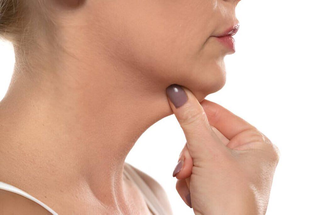 Kybella
