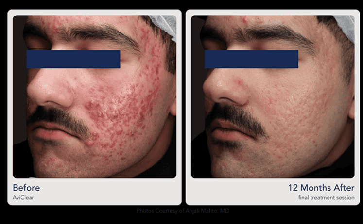Before and after man 12 months