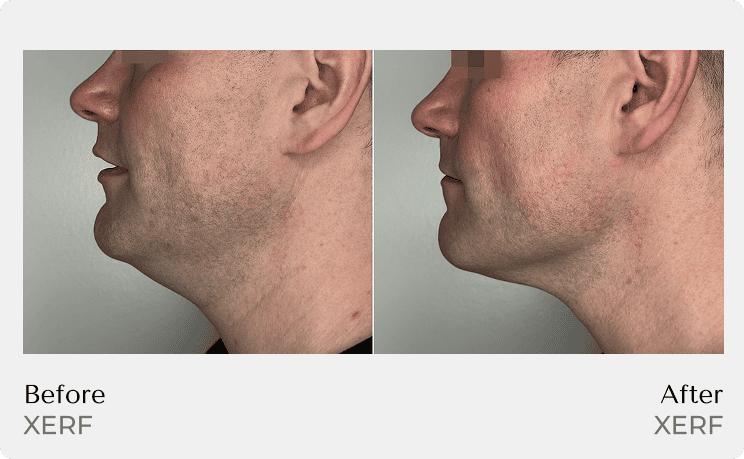 XERF Before and After