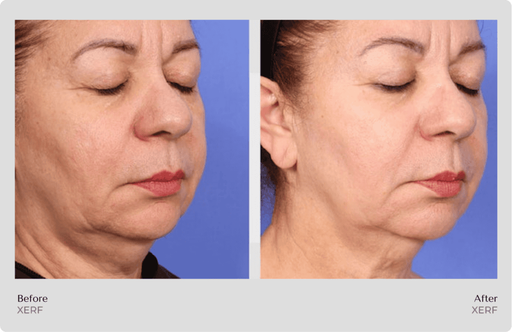 Xerf Before and After