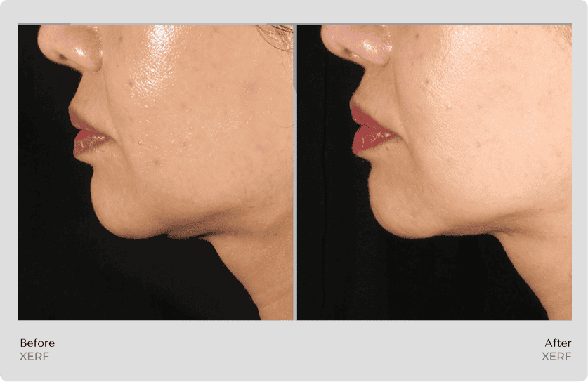 Xerf Before and After