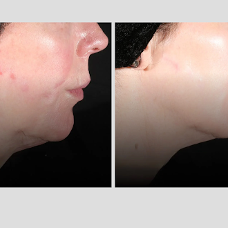 xerf-before-after